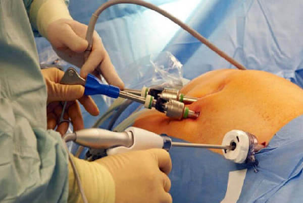 Laparoscopic Surgeries