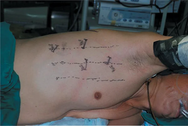 VATS Esophagectomy