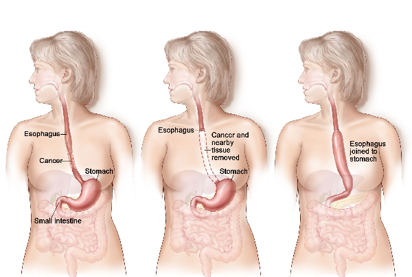 Gastric Pull Up Surgery
