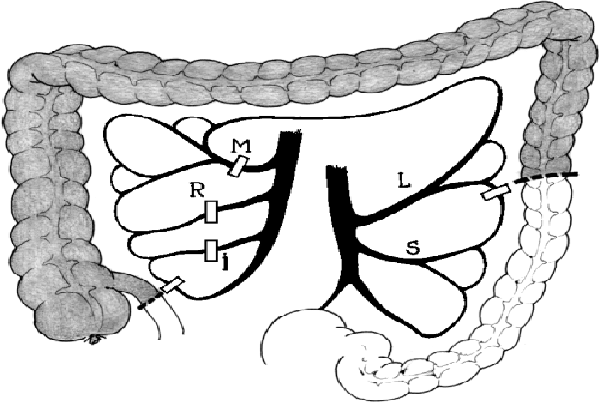 Esophagocoloplasty