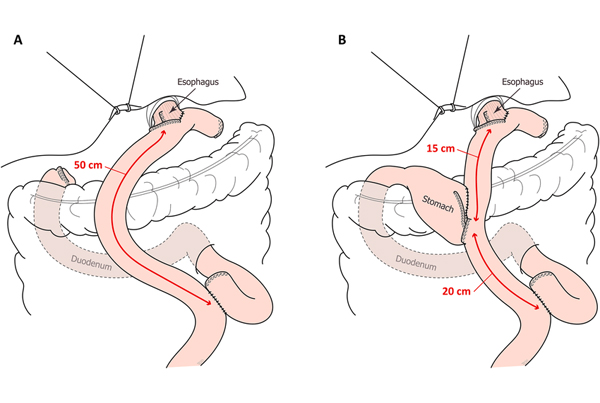 Radical Gastrectomy