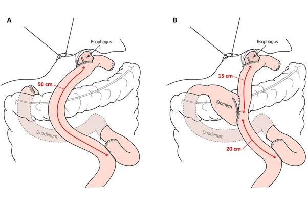 Radical Gastrectomy