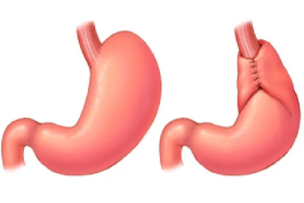 Fundoplication Surgery