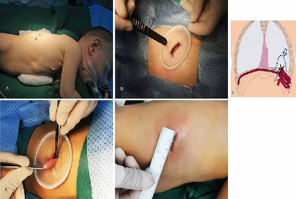 Diaphragmatic Surgeries