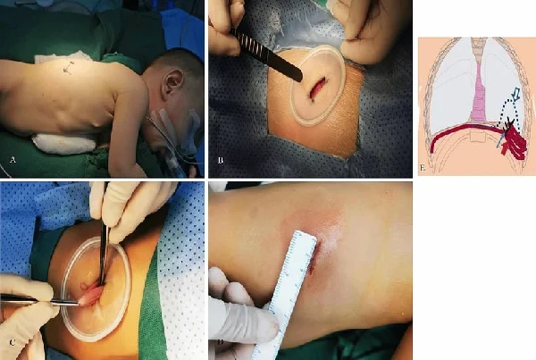 Diaphragmatic Surgeries
