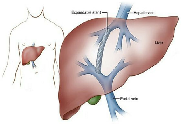 Porto-Caval Shunt Surgeries