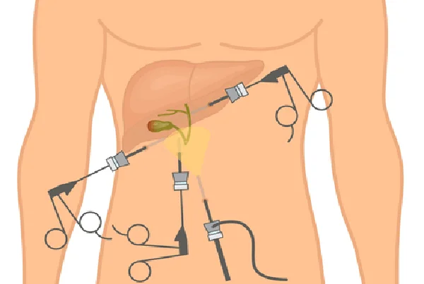 Laparoscopic Cholecystectomy