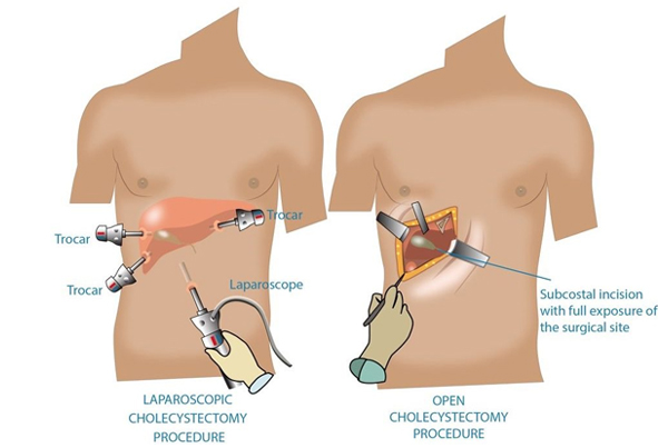 Radical Cholecystectomy