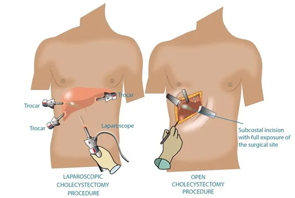 Radical Cholecystectomy