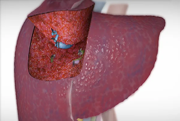 Liver Resection Surgery