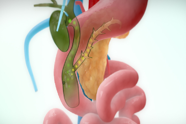 Choledochal Cyst Surgery