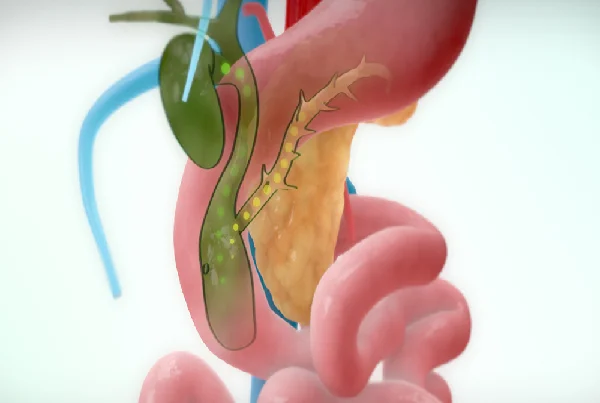 Choledochal Cyst Surgery