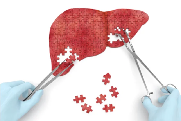 Hepatocellular Cancer Surgery