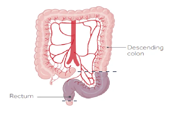 Anterior Resection