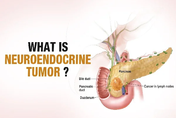 Neuroendocrine Tumor Management
