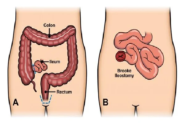 Ulcerative Colitis Surgery